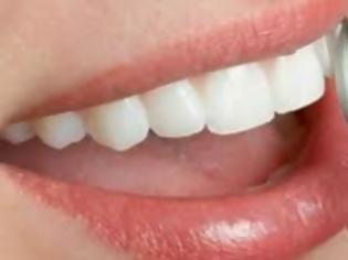 Φωτογραφία για Όλα όσα χρειάζεται να ξέρετε για τη λεύκανση δοντιών