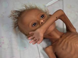 Φωτογραφία για Έκκληση του ΟΗΕ για την Υεμένη: «Στα πρόθυρα λιμού η χώρα»