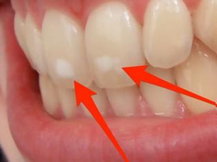 Φωτογραφία για Πού οφείλονται αυτά τα λευκά σημάδια στα δόντια – Τι πρέπει να κάνετε...