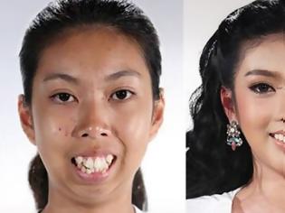 Φωτογραφία για Ένα 19χρονο κορίτσι πριν και μετά τις πλαστικές επεμβάσεις