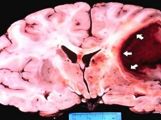 Φωτογραφία για Βόμβα Ο καρκίνος ξεκινά από το μυαλό - Τα σημεία που «χτυπά» ανάλογα με τη διάθεση μας... (βίντεο)