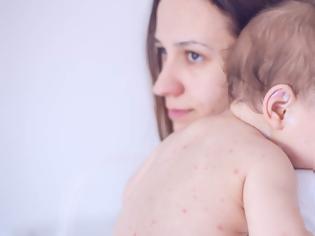 Φωτογραφία για Επιδημία ιλαράς εξαιτίας του «εφιάλτη» των μη-εμβολιασμών – Προσοχή στα συμπτώματα