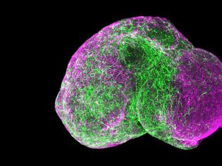 Φωτογραφία για Αυτισμός: Δημιούργησαν «μίνι-εγκεφάλους» σε εργαστήριο και «διόρθωσαν» τα προβληματικά κύτταρα