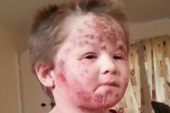 Σφίχτηε η καρδιά μας: 5χρονo παιδάκι έγδερνε το δέρμα του επειδή εθίστηκε στα στεροειδή της αλοιφής και δημιουργήθηκε τρομερό έκζεμα