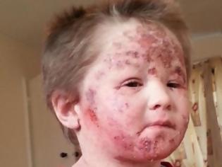 Φωτογραφία για Σφίχτηε η καρδιά μας: 5χρονo παιδάκι έγδερνε το δέρμα του επειδή εθίστηκε στα στεροειδή της αλοιφής και δημιουργήθηκε τρομερό έκζεμα