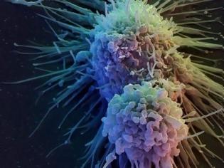 Φωτογραφία για Τεστ αίματος ανιχνεύει τον καρκίνο ένα χρόνο πριν από τις ακτινογραφίες και τις τομογραφίες