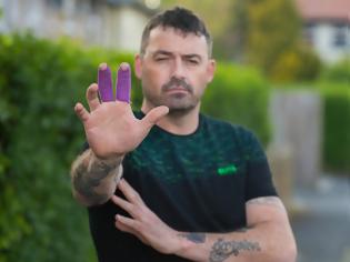 Φωτογραφία για Ένα ακόμη iphone 7 εξερράγη στα χέρια του ιδιοκτήτη του τραυματίζοντας τα δάχτυλα του