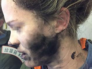 Φωτογραφία για Η Apple αρνήθηκε να αποζημιώσει την γυναίκα που τραυματίστηκε από έκρηξη των ακουστικών που πουλά η ίδια