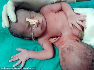 Φωτογραφία για Θυμάστε τον μικρούλη που γεννήθηκε με ένα επιπλέον κεφάλι στα πλευρά του; δείτε πως έγινε χάρη στη επίμονη των γιατρών