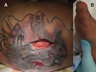 Φωτογραφία για Συναγερμός: Νεκρός 31χρονος από σαρκοφάγο βακτήριο – Μολύνθηκε το φρέσκο τατουάζ του