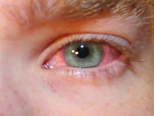 Φωτογραφία για Επιπεφυκίτιδα: Αιτίες και συμπτώματα για ένα πολύ συχνό πρόβλημα στα μάτια