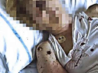 Φωτογραφία για Εικόνες φρίκης: Ηλικιωμένη γεμάτη μυρμήγκια εγκαταλείφθηκε σε νοσοκομείο - Τι λέει ο διευθυντής του νοσοκομείου