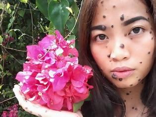 Φωτογραφία για Η 20χρονη με τις ελιές στο πρόσωπο και στο σώμα που θέλει να γίνει Μις Υφήλιος