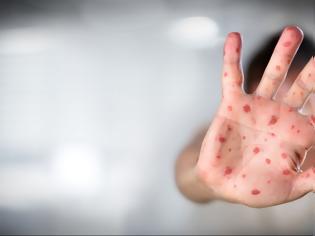 Φωτογραφία για ΠΟΥ: «Απαράδεκτη τραγωδία» οι 35 θάνατοι από ιλαρά στην Ευρώπη