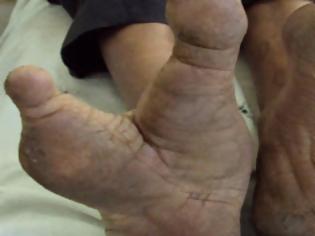 Φωτογραφία για Φυλή Vadoma: Οι άνθρωποι με τα πόδια που θυμίζουν στρουθοκάμηλο (φωτό, βίντεο)
