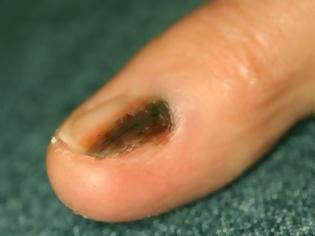 Φωτογραφία για Μελάνωμα στο νύχι, στις άκρες των δακτύλων. Σκούρες γραμμές στα νύχια μπορεί να οφείλονται σε αιμάτωμα ή καρκίνο;