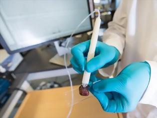 Φωτογραφία για Στυλό για χειρουργούς εντοπίζει τον καρκίνο εντός δευτερολέπτων