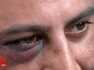 Φωτογραφία για Μαρτυρία θύματος επίθεσης μετά την αντιφασιστική πορεία στο Κερατσίνι: «Με έδειραν με βαριοπούλα και με λήστεψαν» [Βίντεο]