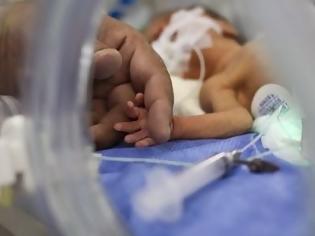 Φωτογραφία για Ένα λιλιπούτειο θαύμα! Το συγκλονιστικό βίντεο ενός μωρού που γεννήθηκε μόλις 500 γραμμάρια... [video]