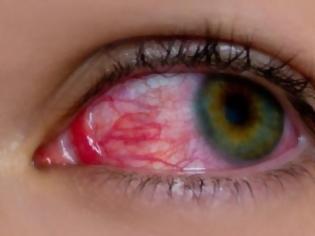 Φωτογραφία για Ραγοειδίτιδα: Τα αίτια και τα συμπτώματα της άγνωστης πάθηση που «απειλεί» την όραση!