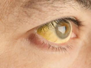 Φωτογραφία για Κίτρινα μάτια: Τι μαρτυρούν για την υγεία σας.
