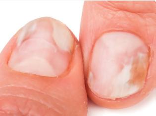 Φωτογραφία για Μύκητες στα νύχια χεριών και ποδιών: Οι 8 κανόνες πρόληψης