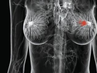 Φωτογραφία για Καρκίνος μαστού: Υποπροϊόν της χοληστερόλης αυξάνει τον κίνδυνο μετάστασης