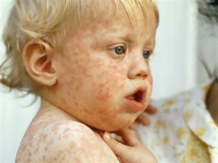 Φωτογραφία για Ο πρώτος θάνατος από ιλαρά σε παιδί 11 μηνών! Συναγερμός στο ΚΕΕΛΠΝΟ