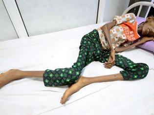 Φωτογραφία για ΟΗΕ: Σοκαριστική η κατάσταση στην Υεμένη