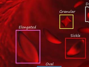 Φωτογραφία για Σύστημα τεχνητής νοημοσύνης ταυτοποιεί τα ερυθρά αιμοσφαίρια