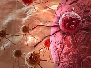Φωτογραφία για Καρκίνος του στομάχου: Ποια τα απλά συμπτώματα που πρέπει να προσέχετε