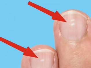 Φωτογραφία για Τι δείχνουν τα λευκά σημάδια στα νύχια για την υγεία μας;
