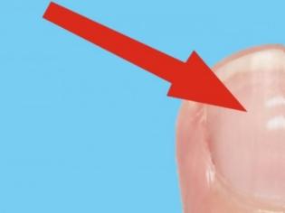Φωτογραφία για Τι δείχνουν τα λευκά σημάδια στα νύχια για την υγεία μας;