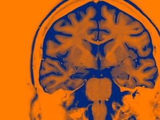 Φωτογραφία για Υπό κλινική δοκιμή τα πρώτα εγκεφαλικά εμφυτεύματα τεχνητής νοημοσύνης
