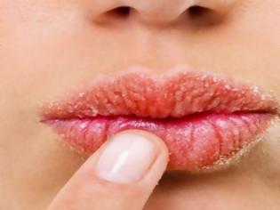 Φωτογραφία για Χείλη σκασμένα από το κρύο: Δείτε τι μπορείτε να κάνετε