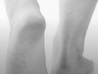 Φωτογραφία για Οι κάλοι συνδέονται με τον καρκίνο - Μεγάλη προσοχή