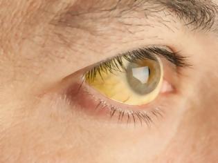 Φωτογραφία για Κίτρινα μάτια: Προσοχή στην ανεβασμένη χολερυθρίνη – Τι πρέπει να ξέρετε