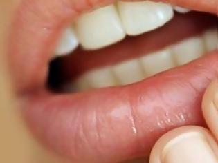Φωτογραφία για Άφθες στο στόμα: Τι τις προκαλεί, πώς θα τις αντιμετωπίσετε