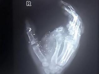 Φωτογραφία για Δωδεκάχρονος έχασε ένα δάχτυλο και την όρασή του από έκρηξη κινητού [Video]
