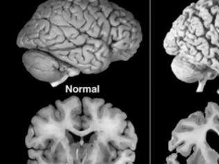 Φωτογραφία για Διάγνωση του Αλτσχάιμερ μια δεκαετία πριν εκδηλωθεί