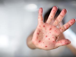 Φωτογραφία για Μία 35χρονη το τρίτο θύμα της ιλαράς - Προβληματισμός στο ΚΕΕΛΠΝΟ