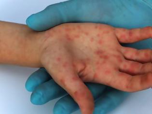 Φωτογραφία για Πρόεδρος ΚΕΕΛΠΝΟ: Προβληματισμός για την επιδημία ιλαράς που δεν φαίνεται να σταματάει