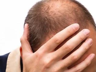Φωτογραφία για Γιατί κάποιοι άνδρες χάνουν πρόωρα τα μαλλιά τους;