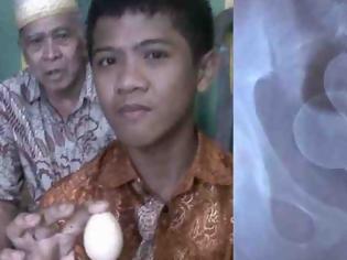 Φωτογραφία για Ανεξήγητο φαινόμενο Οι επιστήμονες τρελάθηκαν: 14χρονος «γεννά» αυγά στην Ινδονησία