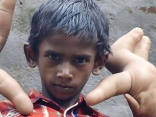 Φωτογραφία για Ινδία: Η ιστορία του αγοριού με τα μεγαλύτερα χέρια στον κόσμο... [photo]