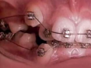 Φωτογραφία για ΑΠΙΣΤΕΥΤΟ VIDEO: Δείτε σε γρήγορη κίνηση πως τα σιδεράκια ισιώνουν τα δόντια…