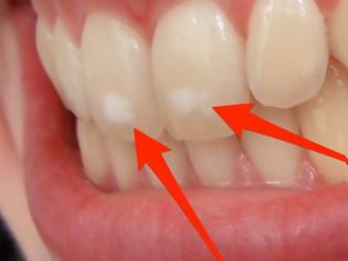 Φωτογραφία για Πού οφείλονται αυτά τα λευκά σημάδια στα δόντια – Τι πρέπει να κάνετε