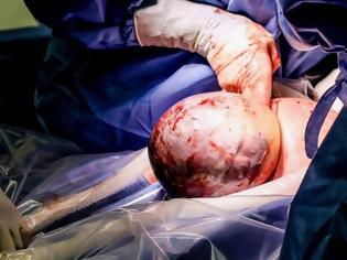 Φωτογραφία για Απίστευτες εικόνες: Σπάνια γέννηση μωρού με το κεφάλι στον αμνιακό σάκο