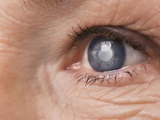 Φωτογραφία για Θεραπεία βλαστοκυττάρων αποκατέστησε την όραση ηλικιωμένων ένα βήμα πριν την τύφλωση