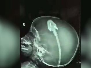 Φωτογραφία για Η ακτινογραφία αυτού του μικρού παιδιού έχει γίνει διεθνές πρωτοσέλιδο - Σοκαρισμένοι οι γιατροί δεν μπορούν να πιστέψουν ότι... [video]